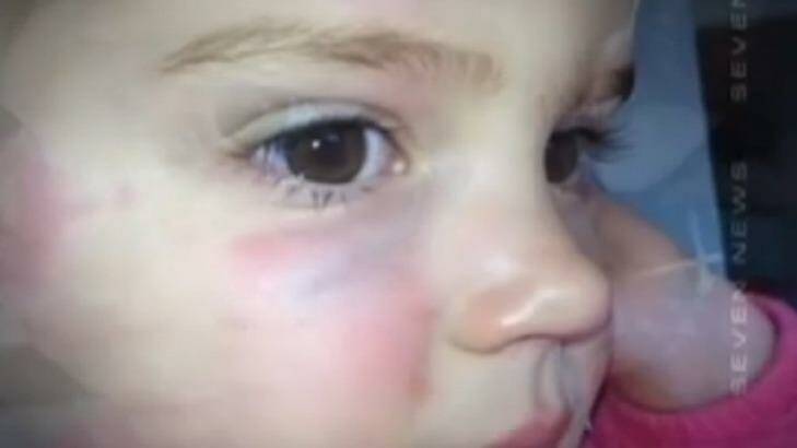 "Somebody has failed": Eva Ness, 2, was attacked by an older boy at a Sydney creche. Photo: Channel Seven