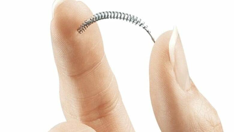 The birth control implant Essure. Photo: AAP
